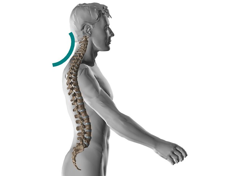 Цервикална остеохондроза на гръбначния стълб, причиняваща много неприятни симптоми